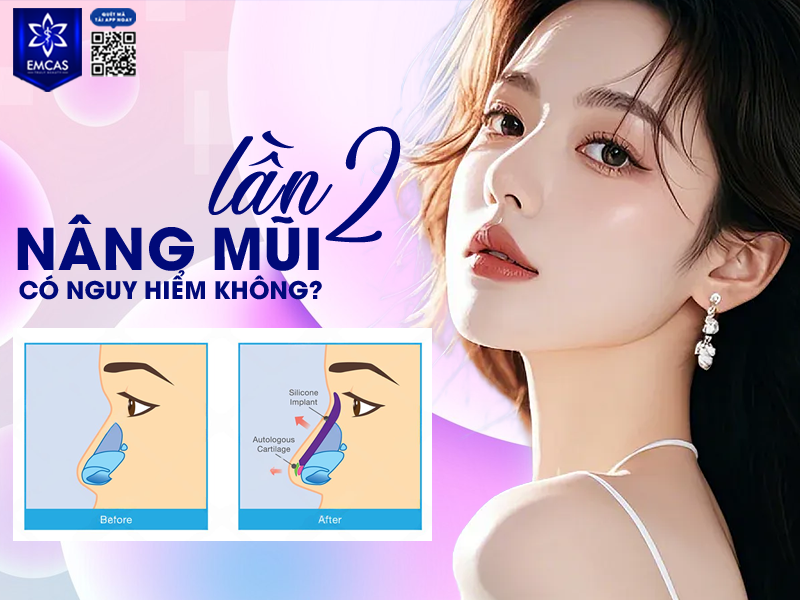 Lựa Chọn Nào Cho Người Nâng Mũi Lần 2?