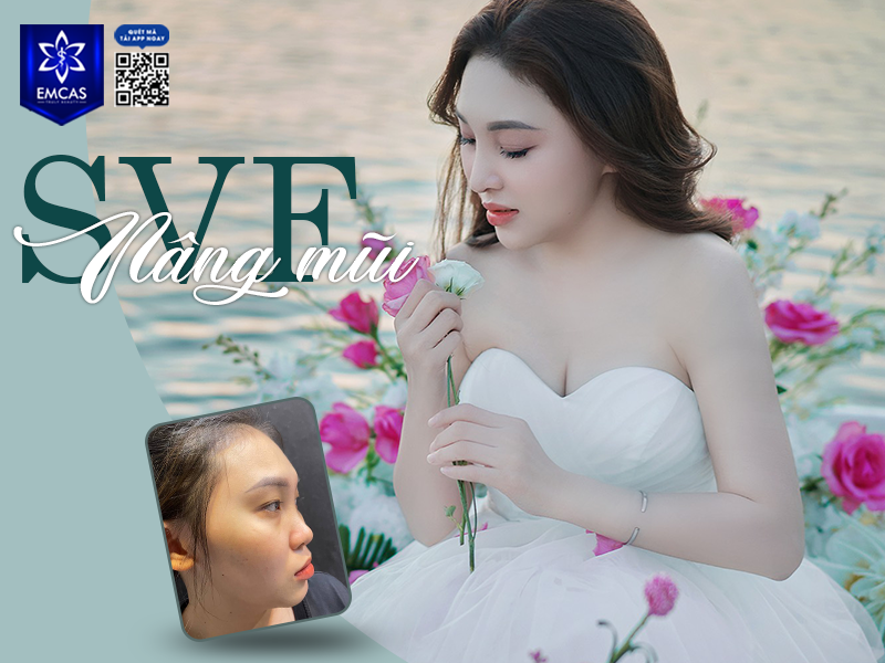 Lý Do Nên Chọn Nâng Mũi SVF Thay Vì Phương Pháp Truyền Thống