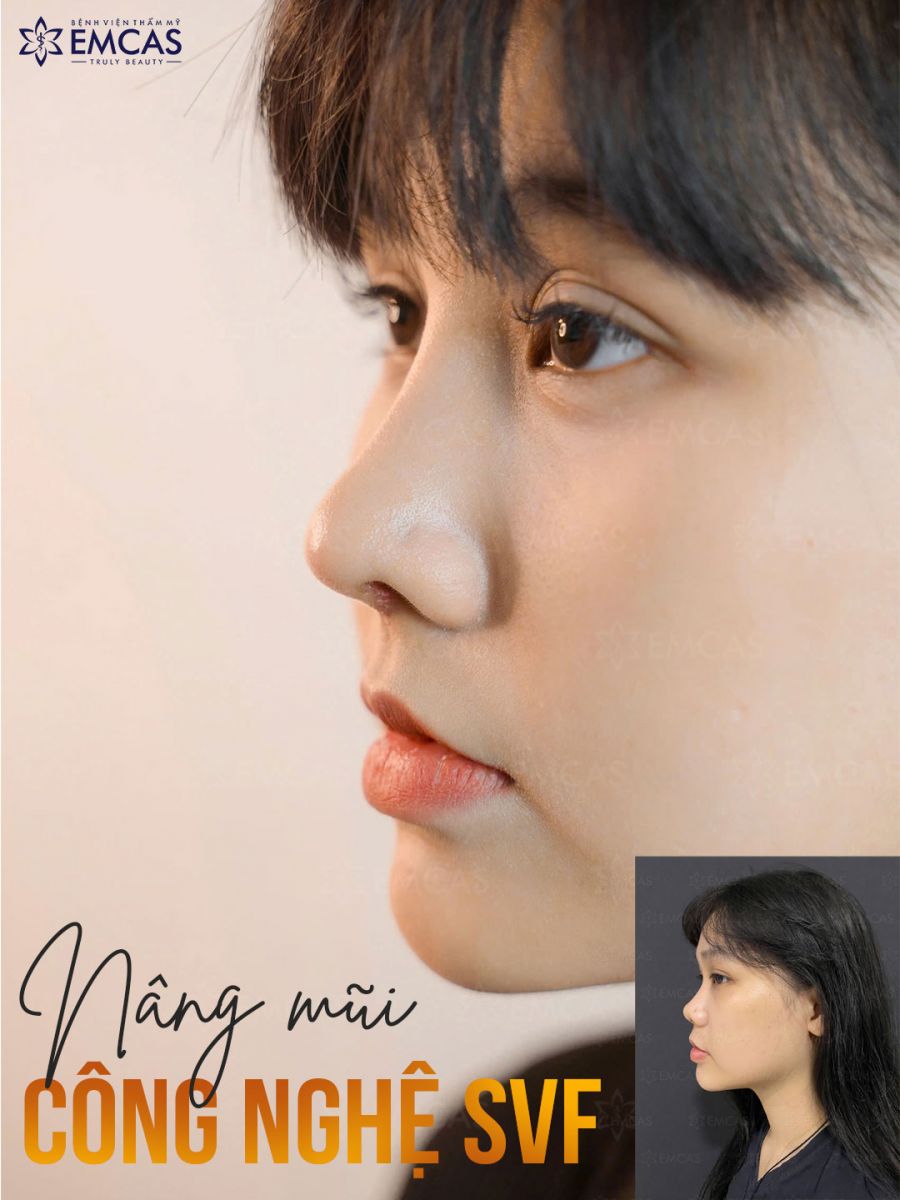 Vì Sao Nên Lựa Chọn Nâng Mũi SVF?