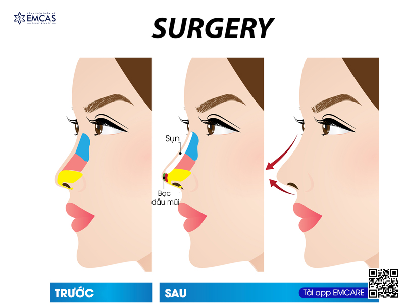Những Suy Nghĩ Sai Lầm Về Nâng Mũi Có Thể Bạn Chưa Biết