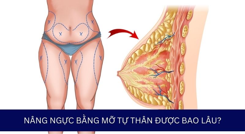 Nâng Ngực Bằng Mỡ Tự Thân Được Bao Lâu?