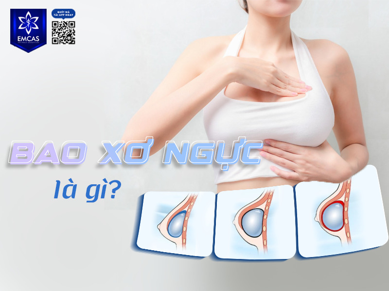 Bao xơ ngực là sự hình thành một lớp màng bọc cứng bao xung quanh túi độn nhằm cô lập và bảo vệ cơ thể trước vật liệu nhân tạo.