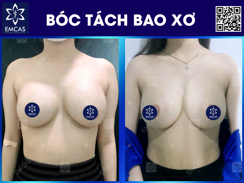 Bao xơ ngực không phải là biến chứng ngẫu nhiên, mà thường hình thành do nhiều yếu tố khác nhau.