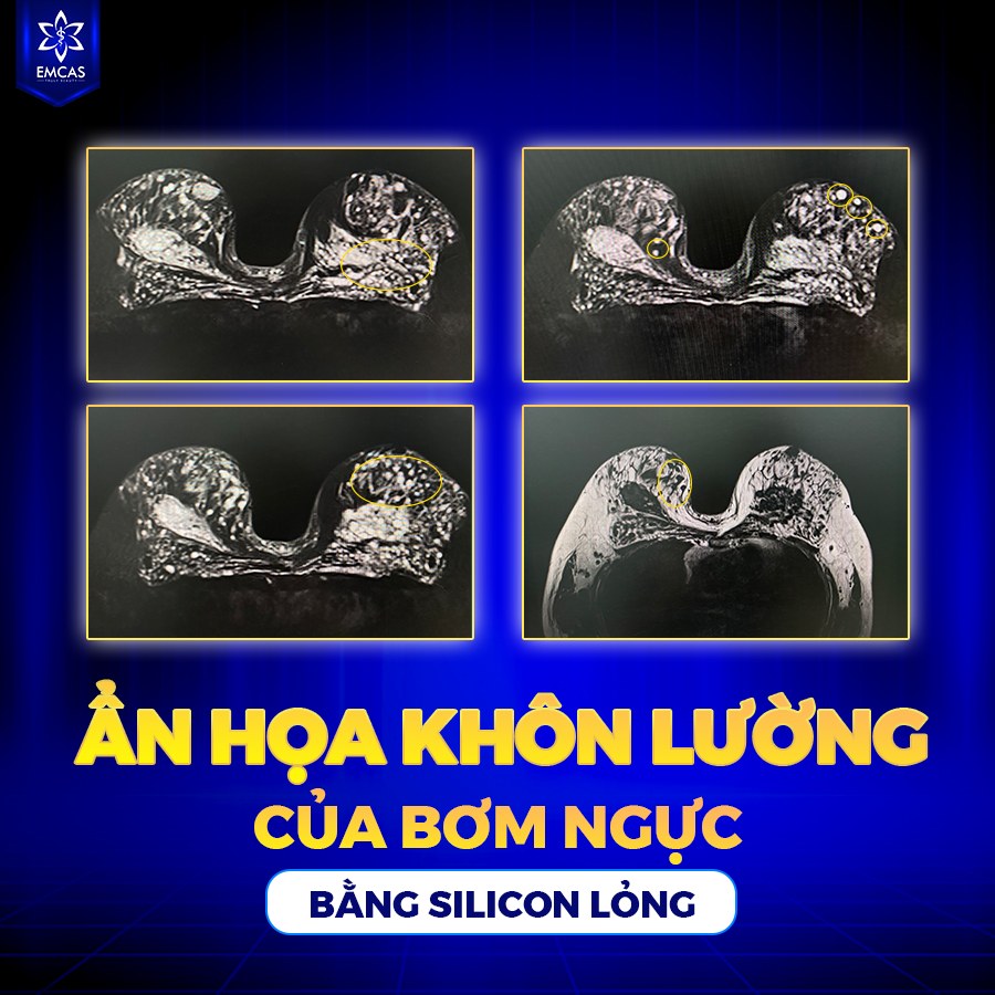 Bơm ngực silicon thường được hiểu là phương pháp đưa silicon lỏng trực tiếp vào mô ngực để làm tăng thể tích vòng 1.