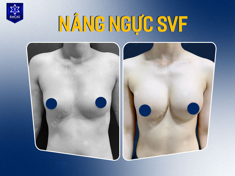 Người muốn cải thiện vòng 1 nên bắt đầu bằng buổi thăm khám với bác sĩ chuyên khoa để đánh giá mô ngực, da, thành ngực, sức khỏe tổng quát và mục tiêu thẩm mỹ.