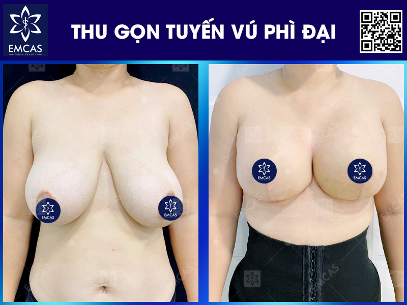 Phẫu thuật thu gọn tuyến vú phì đại giúp cải thiện hiệu quả tình trạng vòng 1 quá lớn, gây mất cân đối cơ thể, đau vai gáy, khó vận động hoặc ảnh hưởng đến sinh hoạt hằng ngày.