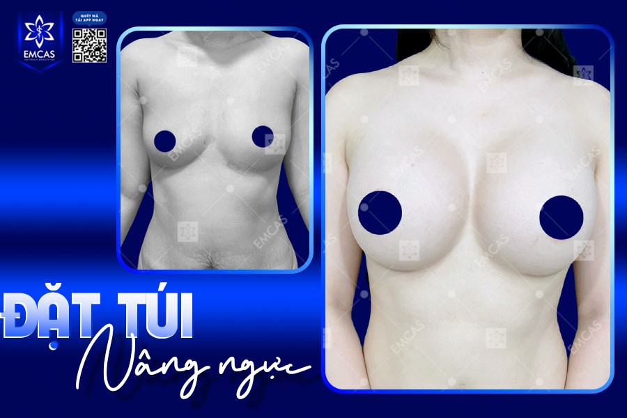 Sau nâng ngực, bạn không cần phải kiêng vận động hoàn toàn mà phải vận động đúng cách và đúng thời điểm.