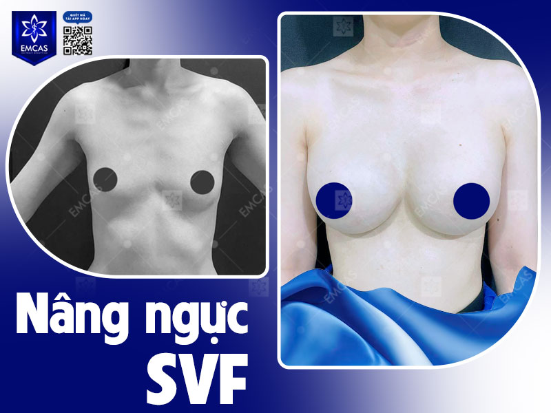 Quyết định nâng ngực là lựa chọn cá nhân nhưng nếu vòng 1 bạn lép bẩm sinh và mong muốn tăng kích thước rõ rệt, lâu dài thì đây là giải pháp phù hợp.