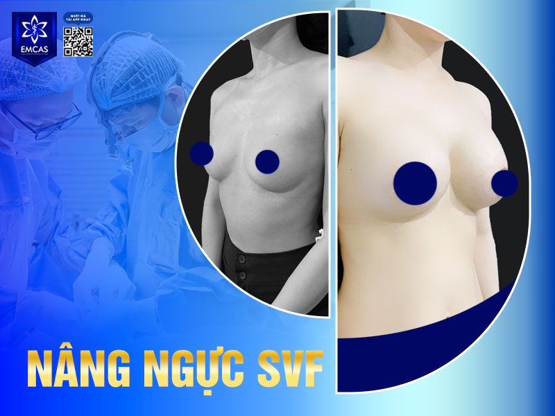 Phẫu thuật nâng ngực không được cách tăng vòng 1 ở tuổi dậy thì được khuyến khích vì cơ thể vẫn đang trong giai đoạn phát triển và chưa hoàn thiện về cả cấu trúc mô tuyến vú lẫn nội tiết.