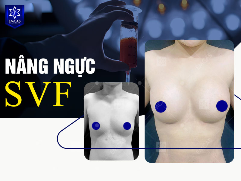 Phẫu thuật nâng vòng 1 sau sinh có thể được cân nhắc khi bầu ngực xẹp, lép, chảy xệ rõ