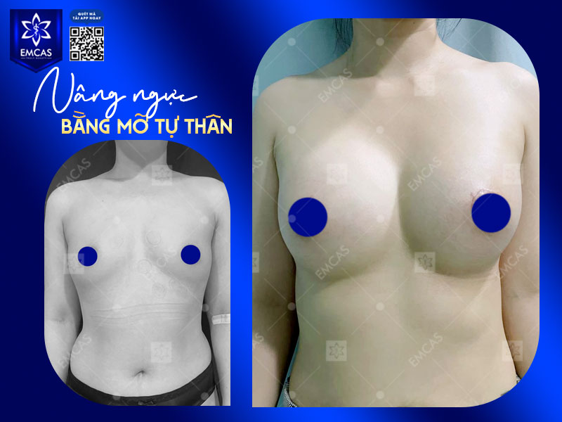 Tại Bệnh Viện Thẩm Mỹ EMCAS, chi phí nâng ngực bằng mỡ tự thân dao động từ 45 triệu đồng trở lên. 