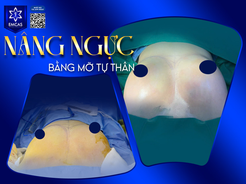 Tại TP.HCM, Bệnh Viện Thẩm Mỹ EMCAS là một trong những đơn vị được nhiều khách hàng tin tưởng khi thực hiện nâng ngực bằng mỡ tự thân.