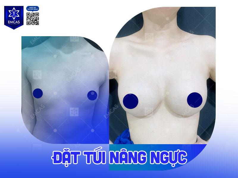 Theo bác sĩ Phạm Xuân Khiêm, việc cải thiện vòng 1 nên được cân nhắc khi bạn thực sự cảm thấy không hài lòng với ngoại hình của mình và điều đó ảnh hưởng đến sự tự tin trong cuộc sống hằng ngày.