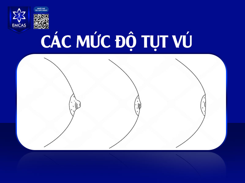 Đầu vú bị tụt vào trong có thể xảy ra ở nhiều mức độ khác nhau, từ nhẹ đến nặng, tùy thuộc vào mức độ co kéo của ống tuyến sữa và mô xơ dưới quầng vú.