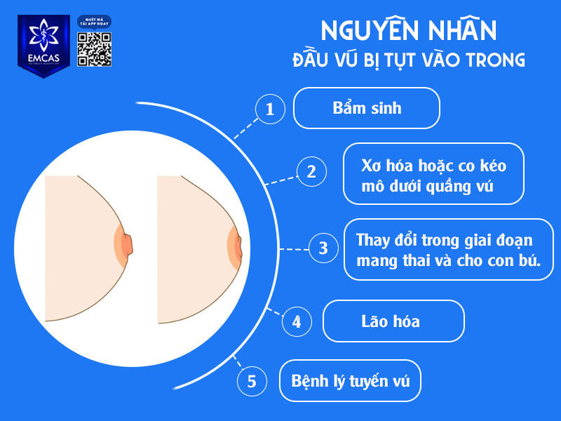 Có nhiều nguyên nhân dẫn đến tình trạng đầu vú bị tụt vào trong, bao gồm cả yếu tố bẩm sinh lẫn các tác động mắc phải trong quá trình trưởng thành.