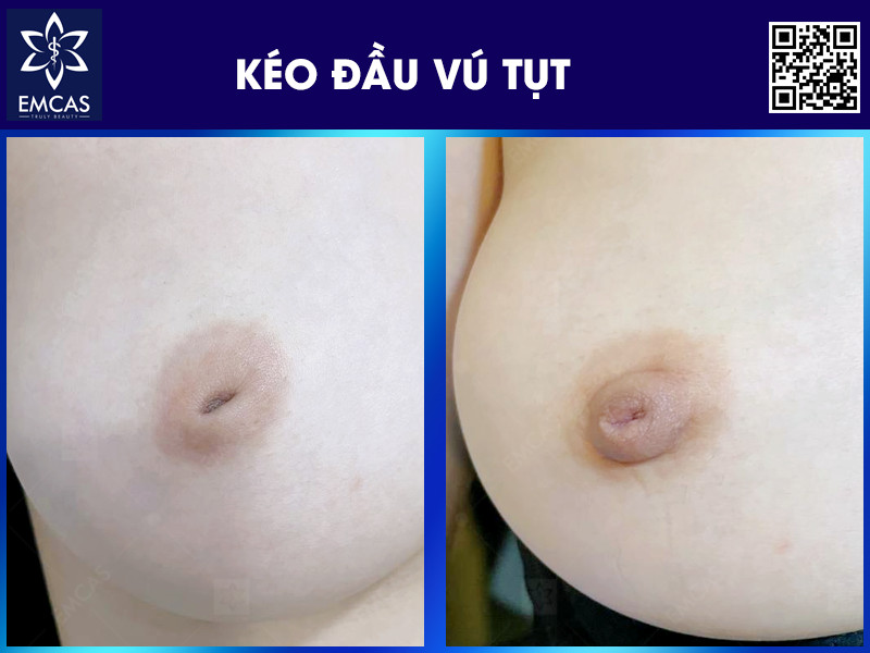 Kéo đầu vú tụt là phương pháp can thiệp y khoa giúp cải thiện tình trạng đầu vú bị tụt vào trong ở mức độ trung bình đến nặng.