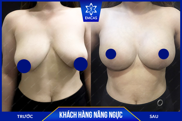 Khách hàng Hoàng Uyên - Review nâng ngực tại EMCAS