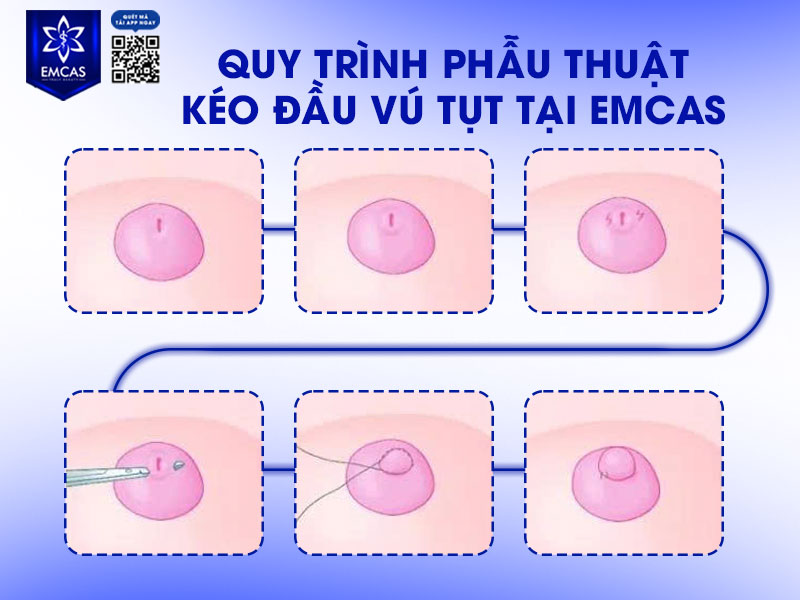 Tại Bệnh Viện Thẩm Mỹ EMCAS, phẫu thuật kéo đầu vú tụt được thực hiện theo quy trình y khoa chuẩn, nhằm đảm bảo an toàn, bảo tồn chức năng,  hạn chế tái tụt 