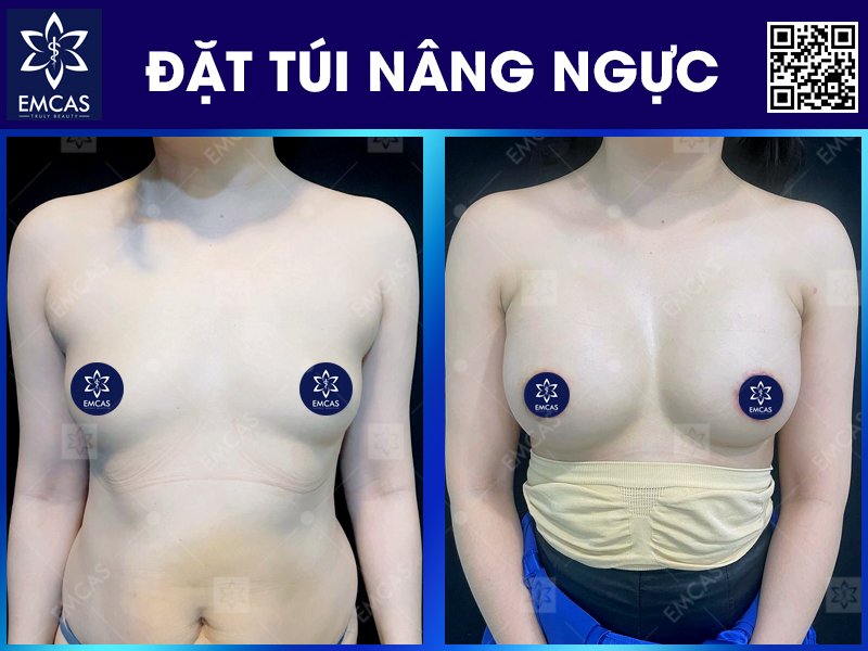 Đặt túi nâng ngực là phương pháp phẫu thuật sử dụng túi độn silicon để tăng kích thước và tạo hình vòng 1 một cách rõ rệt, duy trì hiệu quả lâu dài. 