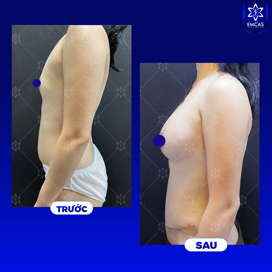 Nâng ngực tự thân là phương pháp cải thiện vòng 1 bằng cách sử dụng một phần da, mỡ, vạt cơ thẳng bụng có cuống mạch máu từ chính cơ thể của bạn để làm đầy ngực. 