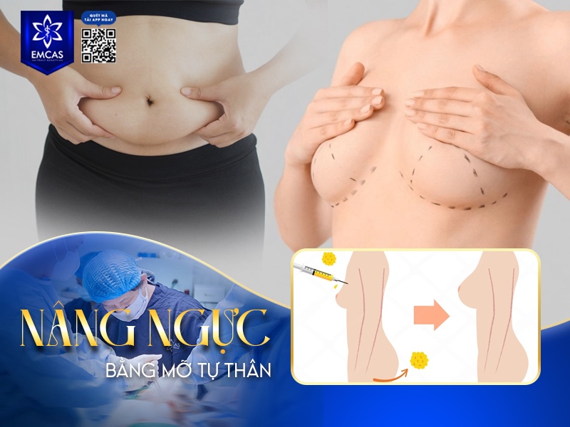 Nâng ngực bằng mỡ tự thân sử dụng chính lượng mỡ thừa được lấy từ các vùng trên cơ thể như bụng, đùi, hông hoặc eo.