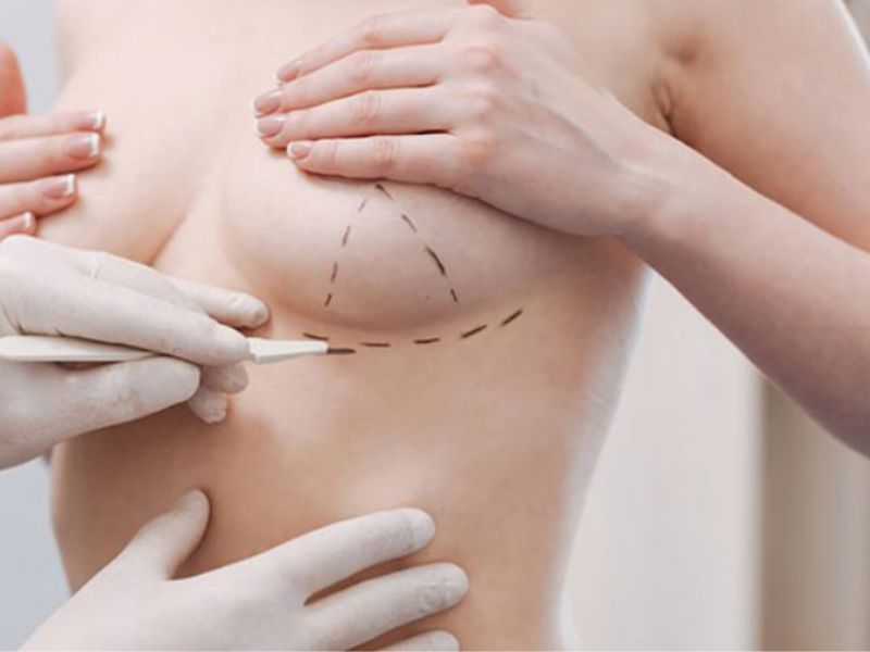 Phụ nữ có ngực nhỏ bẩm sinh muốn cải thiện kích thước để cân đối với cơ thể