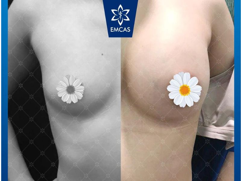 Quy trình thực hiện đặt túi nâng ngực tại EMCAS