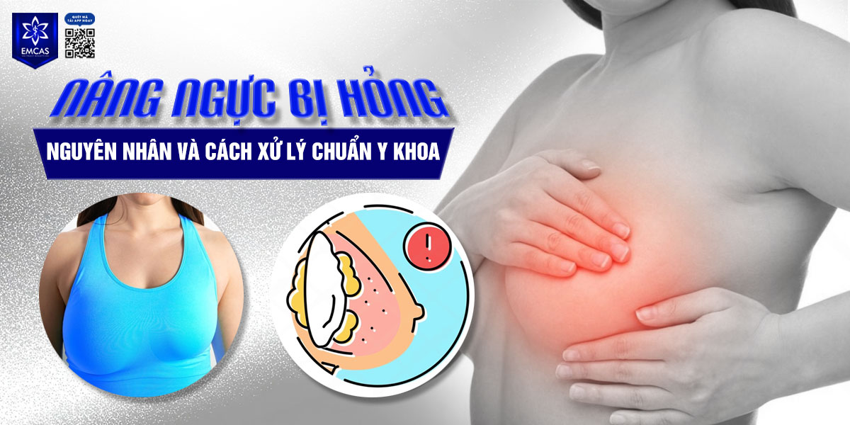 Nâng ngực bị hỏng: Nguyên nhân và cách xử lý chuẩn y khoa