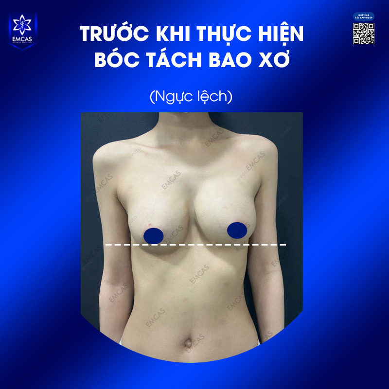 Ngực bị hỏng là thuật ngữ dùng để chỉ các trường hợp kết quả nâng ngực không đạt yêu cầu về thẩm mỹ hoặc xuất hiện các bất thường ảnh hưởng đến hình dáng, cảm giác hay sức khỏe của vòng 1.