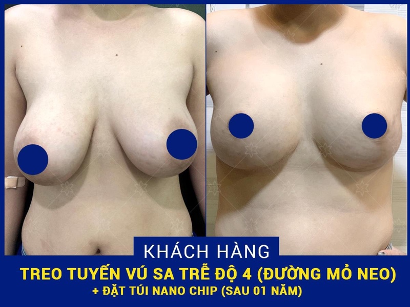 Bệnh viện thẩm mỹ EMCAS là địa chỉ nâng vòng một uy tín được nhiều khách hàng tin tưởng và lựa chọn thẩm mỹ ngực trong 10 năm qua.