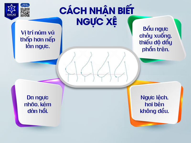 Ngực chảy xệ là tình trạng vòng 1 mất đi độ săn chắc, mô tuyến và da bị giãn khiến ngực không còn giữ được vị trí tự nhiên ban đầu.