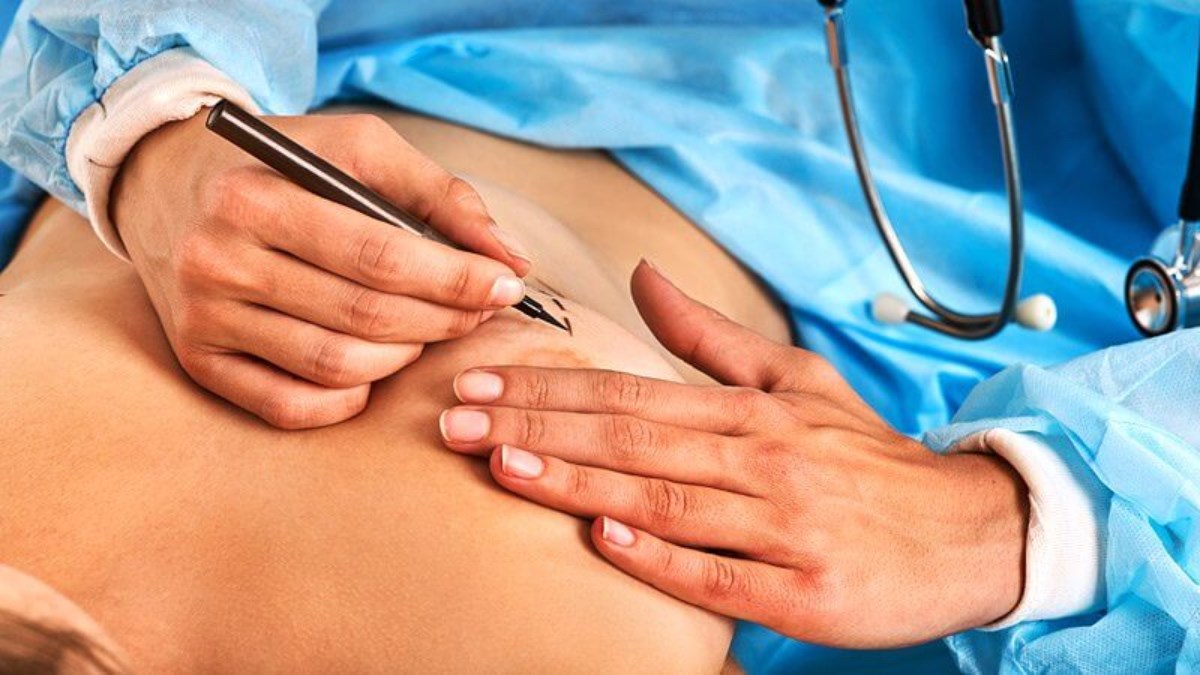 Nâng Ngực Cho Người Chuyển Giới Và Những Điều Cần Biết