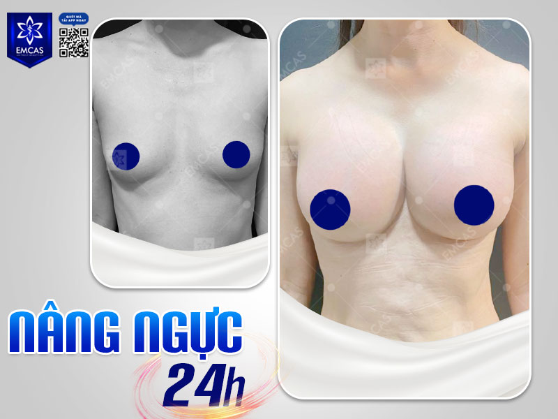 Kỹ thuật nâng ngực 24H tại EMCAS được tối ưu nhằm hạn chế xâm lấn, giảm tổn thương mô và kiểm soát đau hiệu quả.