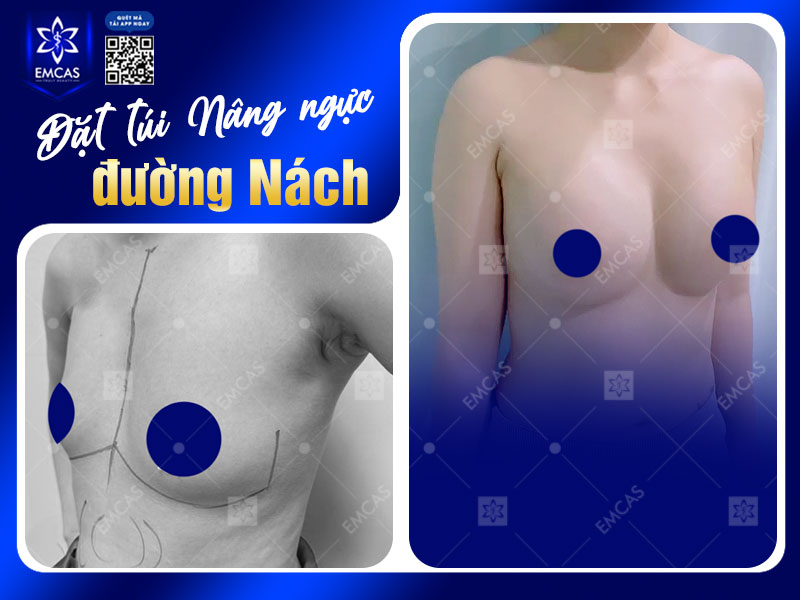 Nâng ngực đường nách có ưu điểm lớn là không để lại sẹo trên bề mặt ngực, giúp giữ vẻ tự nhiên khi nhìn trực diện.
