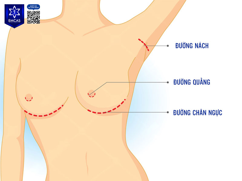 Việc xác định nâng ngực đường nào tốt nhất phụ thuộc vào quá trình thăm khám và phân tích chuyên môn của bác sĩ.