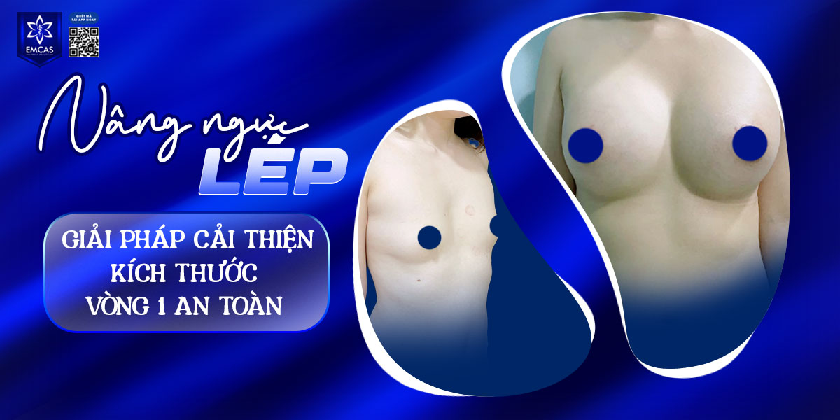 Nâng ngực lép - Giải pháp cải thiện kích thước vòng 1 an toàn