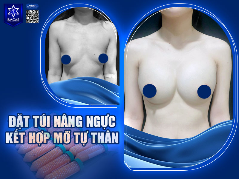 Phương pháp này kết hợp giữa đặt túi độn để tăng kích thước và cấy mỡ tự thân để làm mềm mại, tự nhiên hơn.