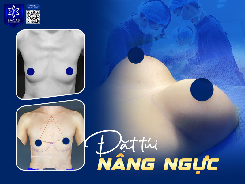 Nâng ngực bằng túi độn là phương pháp nâng ngực phổ biến nhất, sử dụng túi độn silicon đặt vào khoang ngực để tăng kích thước vòng 1.