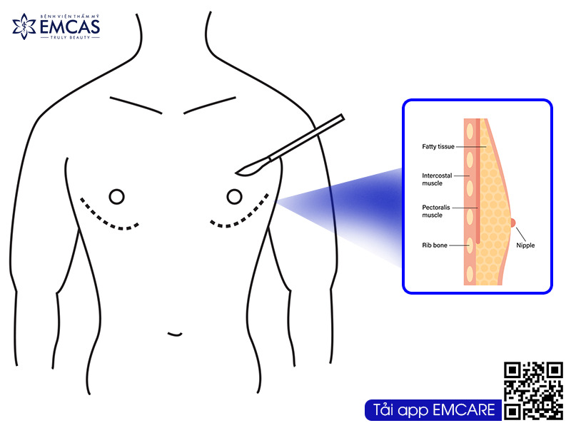 Cấu tạo vùng ngực của nam giới khác với nữ giới. Với các đặc điểm như cơ bắp, nhiều thịt, cơ, các tế bào mô ngực rất nhiều khi cho quá trình nâng ngực cho nam giới trở nên khó khăn hơn.