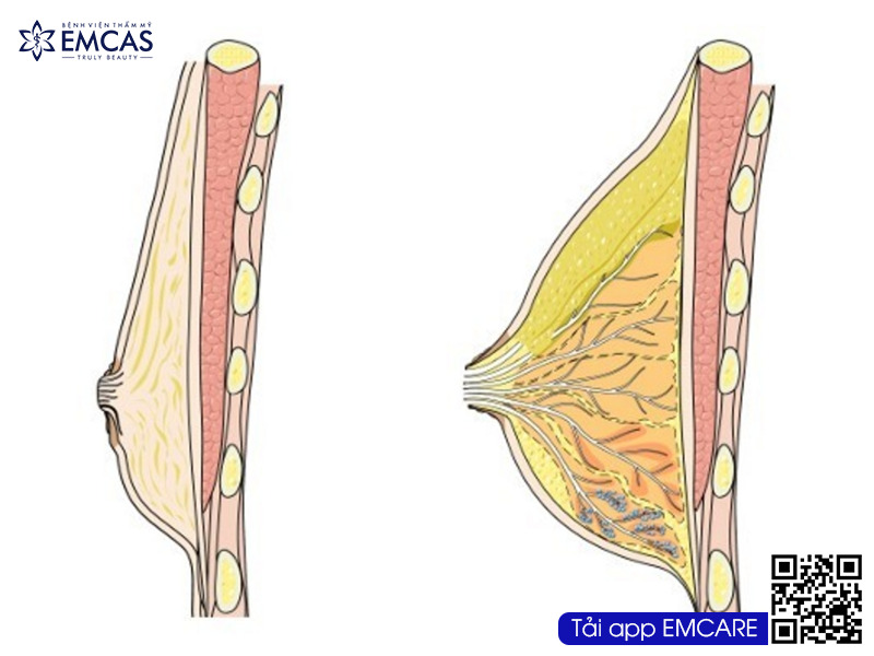 Những điều cần lưu ý khi nâng ngực cho nam giới