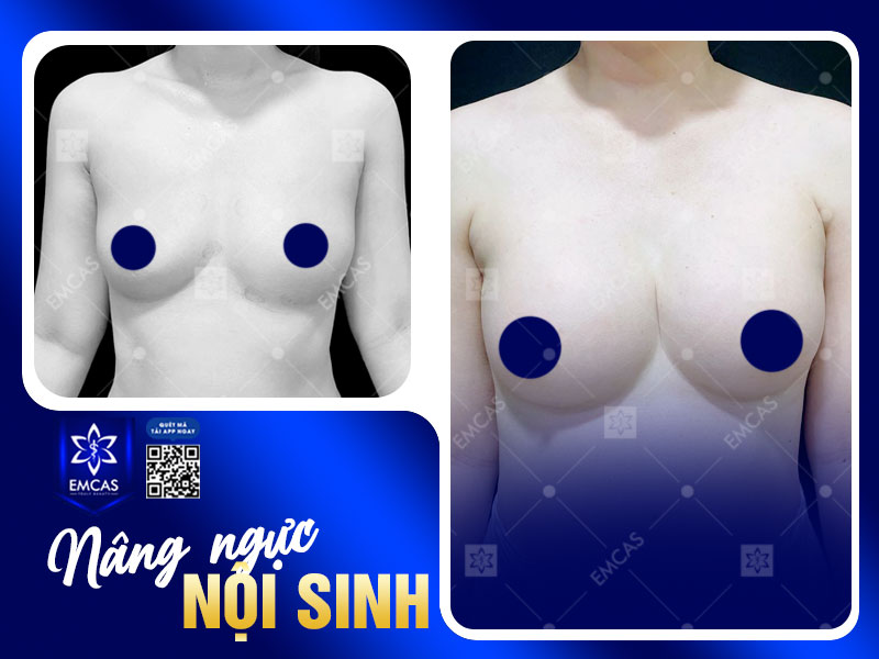 Kết quả nâng ngực nội sinh thường duy trì trong khoảng 3–5 năm, tùy thuộc vào cơ địa, tỷ lệ mỡ sống sau khi cấy và chế độ chăm sóc của mỗi người.