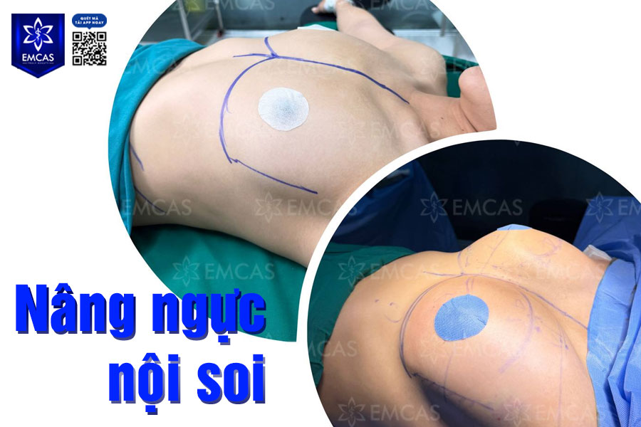Nâng ngực nội soi không nguy hiểm nếu được thực hiện đúng chỉ định, bởi bác sĩ chuyên môn cao và trong phòng mổ vô trùng.