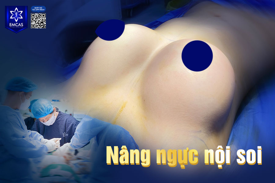 Nâng ngực nội soi là kỹ thuật phẫu thuật đặt túi ngực có sự hỗ trợ của hệ thống camera nội soi chuyên dụng, giúp phóng đại cấu trúc khoang ngực lên màn hình trong quá trình thực hiện.