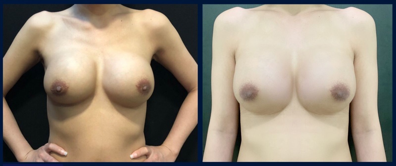 Sau khi phẫu thuật lấy silicon bạn cần nằm lại bệnh viện trong ít nhất 1 ngày trước khi về nhà. Sau khi được xuất viện hãy tuân thủ hướng dẫn chăm sóc vết thương và uống thuốc theo yêu cầu của bác sĩ.