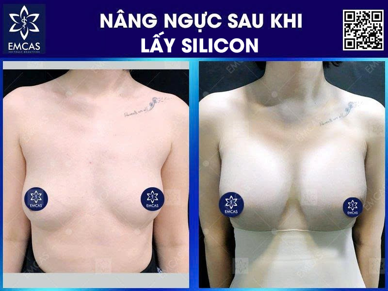 Các bác sĩ EMCAS luôn hướng đến mục tiêu lấy được nhiều nhất lượng silicon trong vùng ngực, mức độ gần như hoàn hảo, lên đến 80 – 85%. Tuy nhiên, một số trường hợp cần thực hiện phẫu thuật lấy silicon nhiều lần.