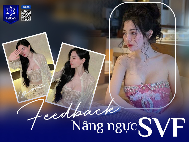 Thay vì chỉ sử dụng túi độn để tăng kích thước vòng 1, nâng ngực SVF còn cấy thêm SVF giàu tế bào gốc giúp tạo dáng ngực đầy đặn, tự nhiên và mềm mại hơn, đồng thời hỗ trợ đẩy nhanh tốc độ lành thương.