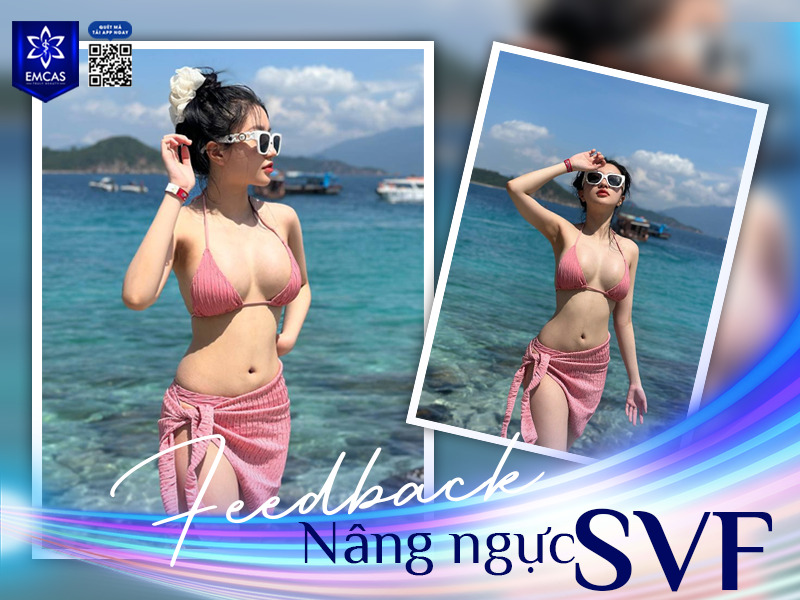 Nâng ngực SVF là phương pháp thẩm mỹ kết hợp giữa túi độn ngực và công nghệ SVF giàu tế bào gốc (Stromal Vascular Fragment). Đây là sự kết hợp hoàn hảo giúp mang lại khuôn ngực căng tròn và tự nhiên hơn.
