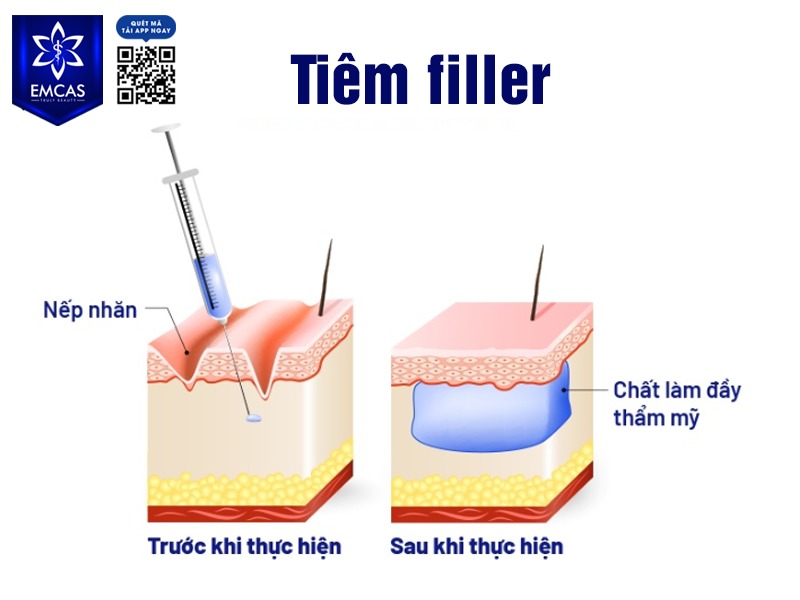 Nâng vú bằng chất làm đầy là một trong những phương pháp thẩm mỹ nâng ngực đã từng rất được ưa chuộng