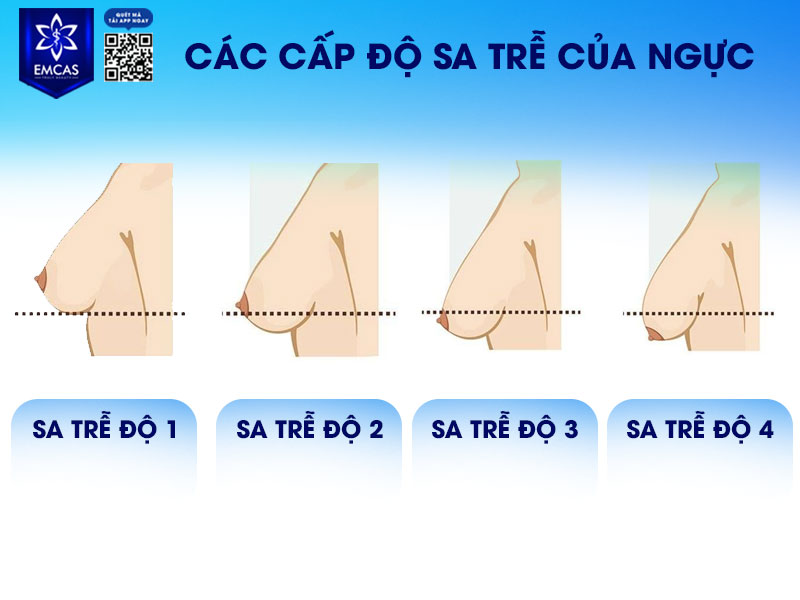 Các cấp độ sa trễ được phân loại dựa trên khoảng cách từ hõm xương ức đến đầu ti.