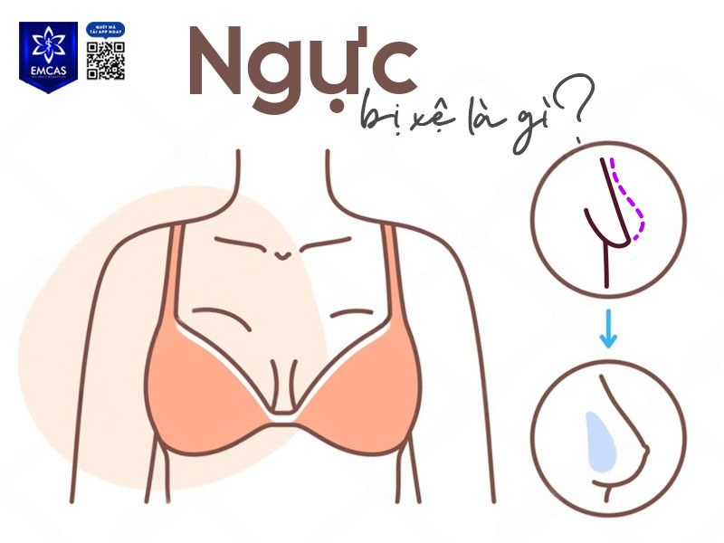 Ngực bị xệ là tình trạng bầu ngực mất đi độ săn chắc, mô ngực và da vùng ngực bị chùng nhão khiến vòng 1 có xu hướng chảy xuống thấp hơn so với vị trí ban đầu.